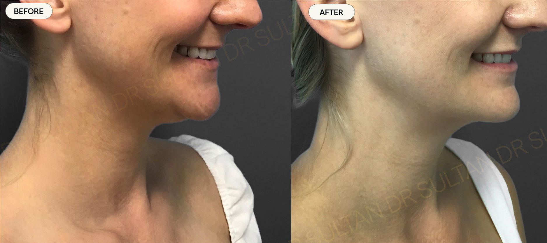 Nonsurgical facelift