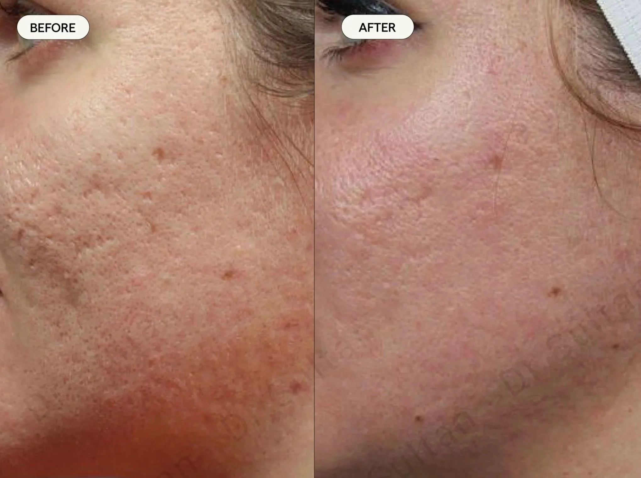 Scars_Acne_02.jpg