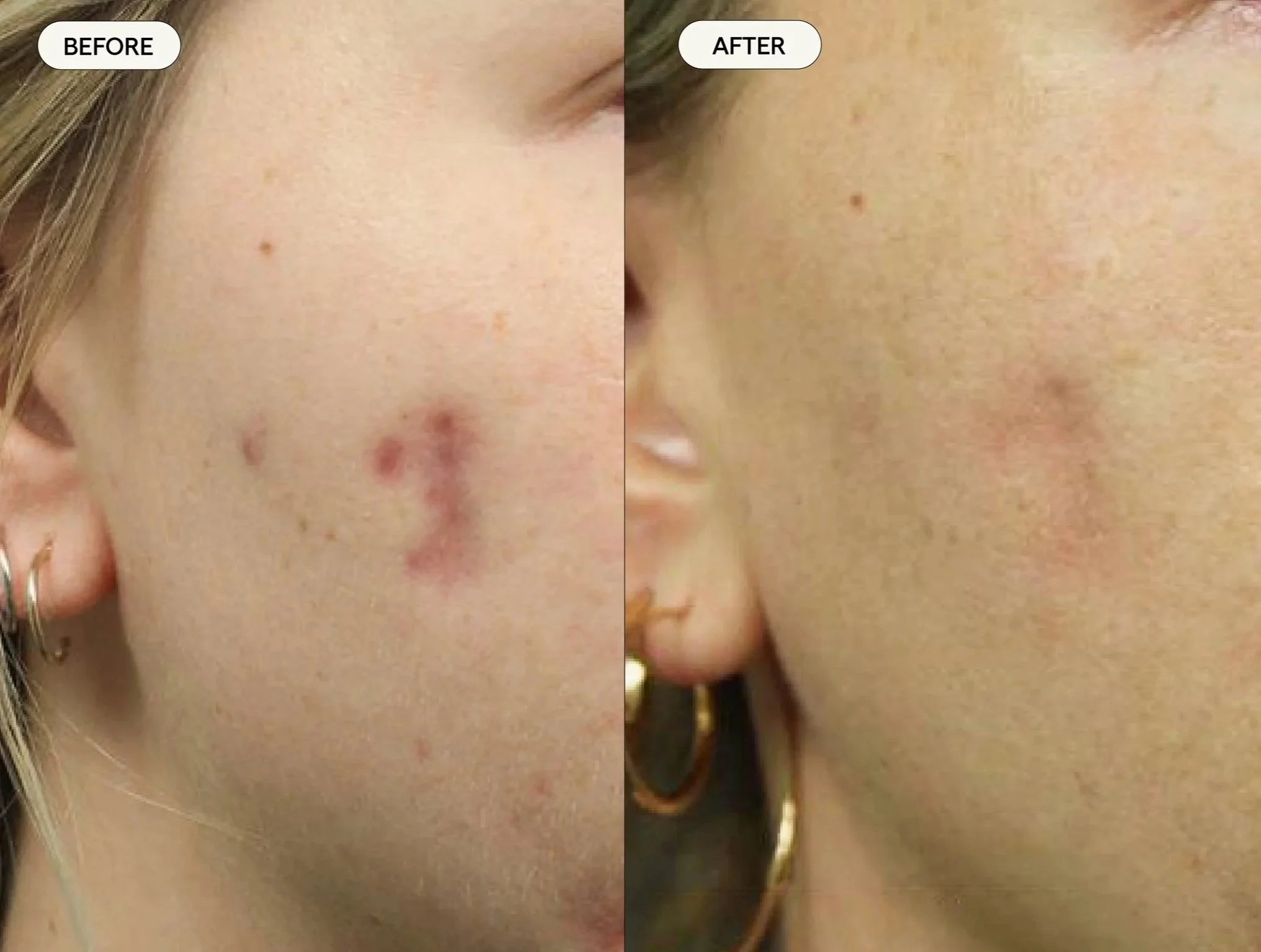 Scars_Acne_03.jpg