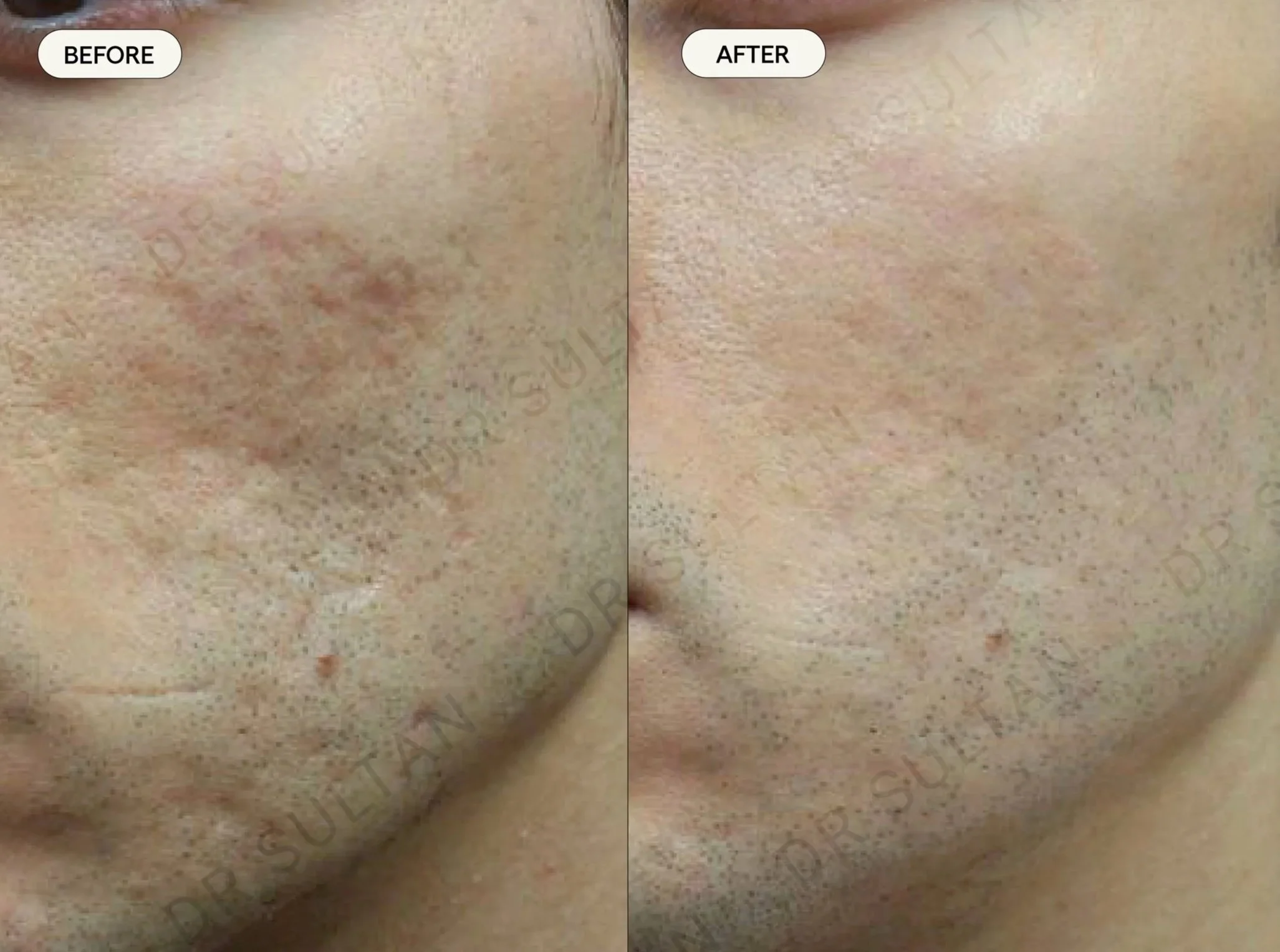 Scars_Acne.jpg