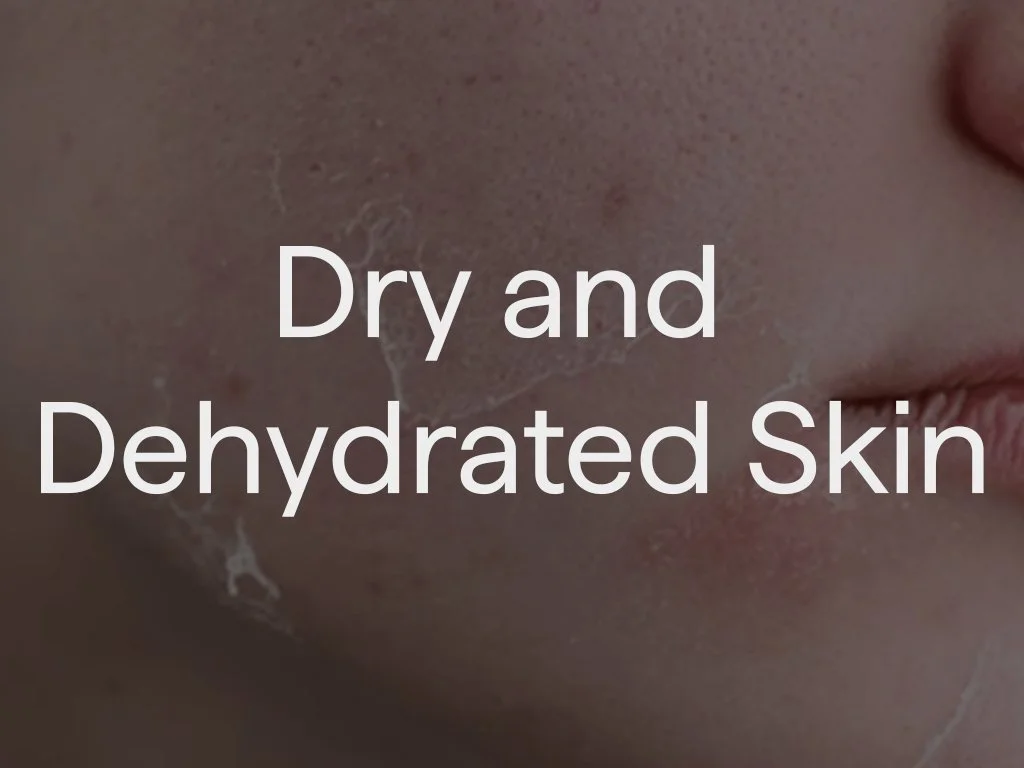 Close-up of dry and dehydrated skin on a person's face, showing flaky and cracked skin texture.