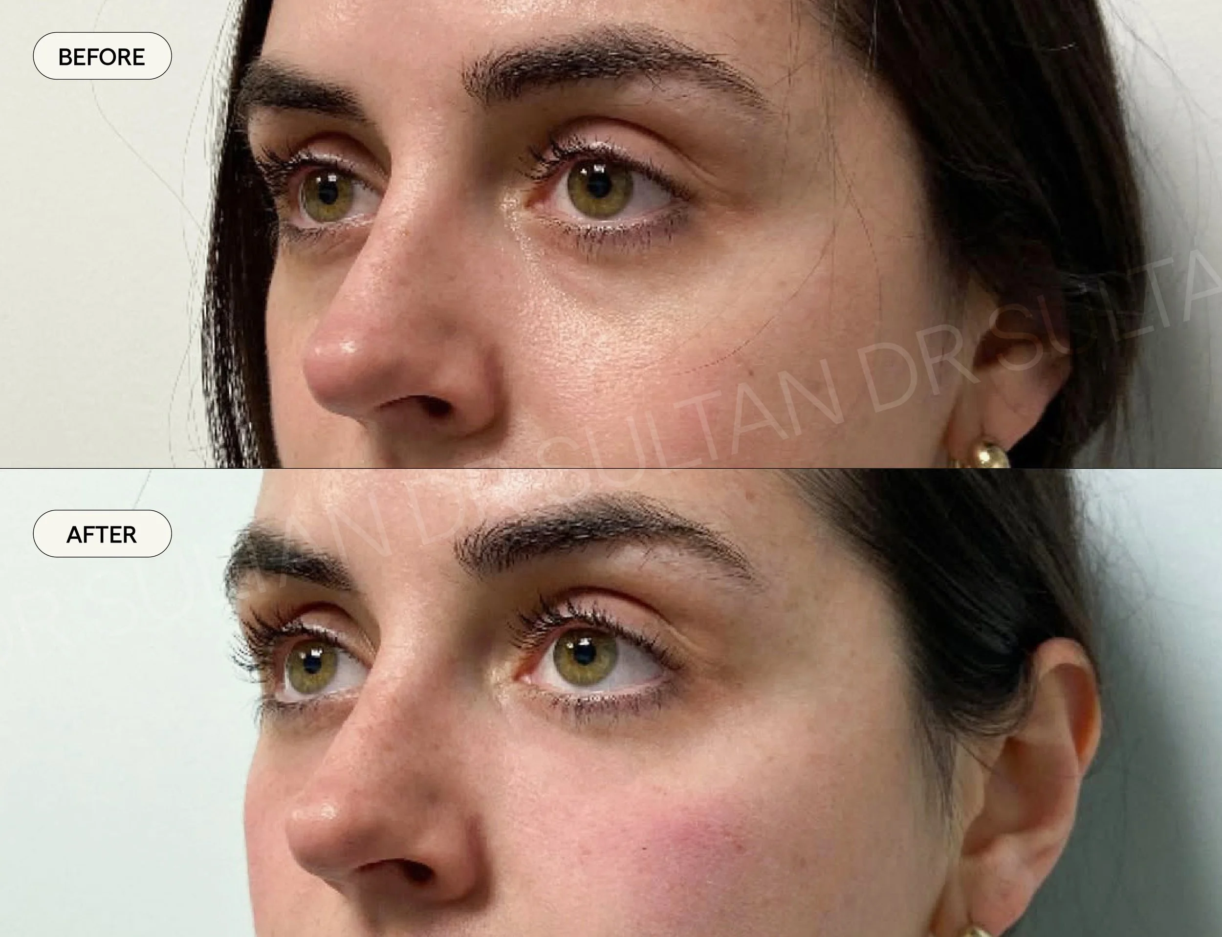 Tear trough rejuvenation with mid face filler and skin boosters 