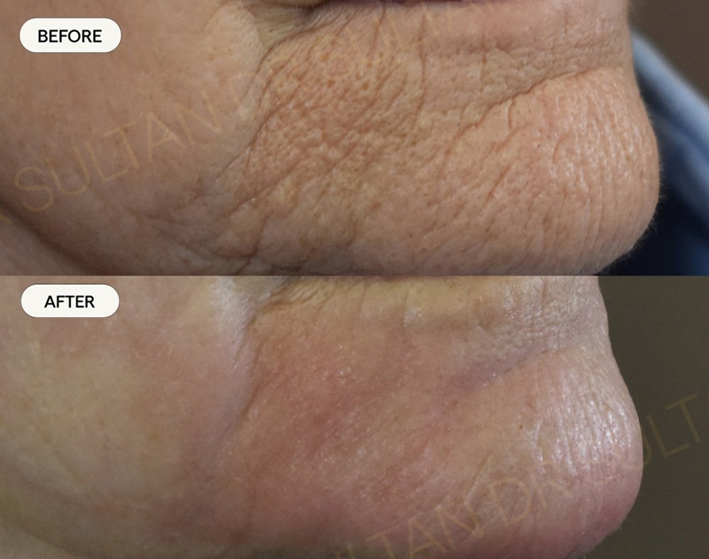 Before and after one session of laser resurfacing for peri-orbital wrinkles 