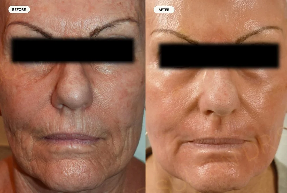 Before and after one session of laser resurfacing for facial wrinkles