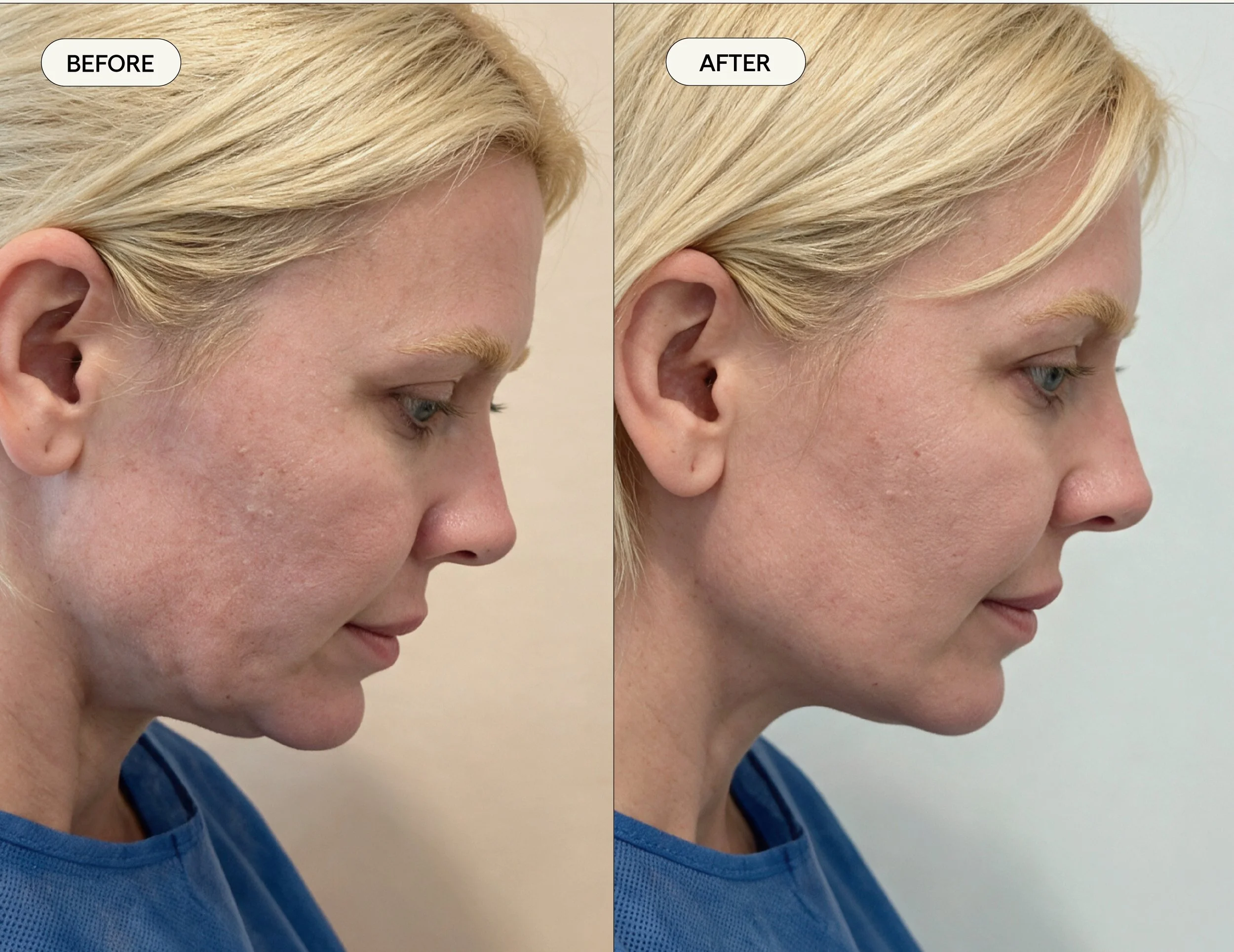 Side-by-side comparison of a woman's neck and jawline before and after a cosmetic procedure jawtite shows a smoother, more defined profile in the after image.