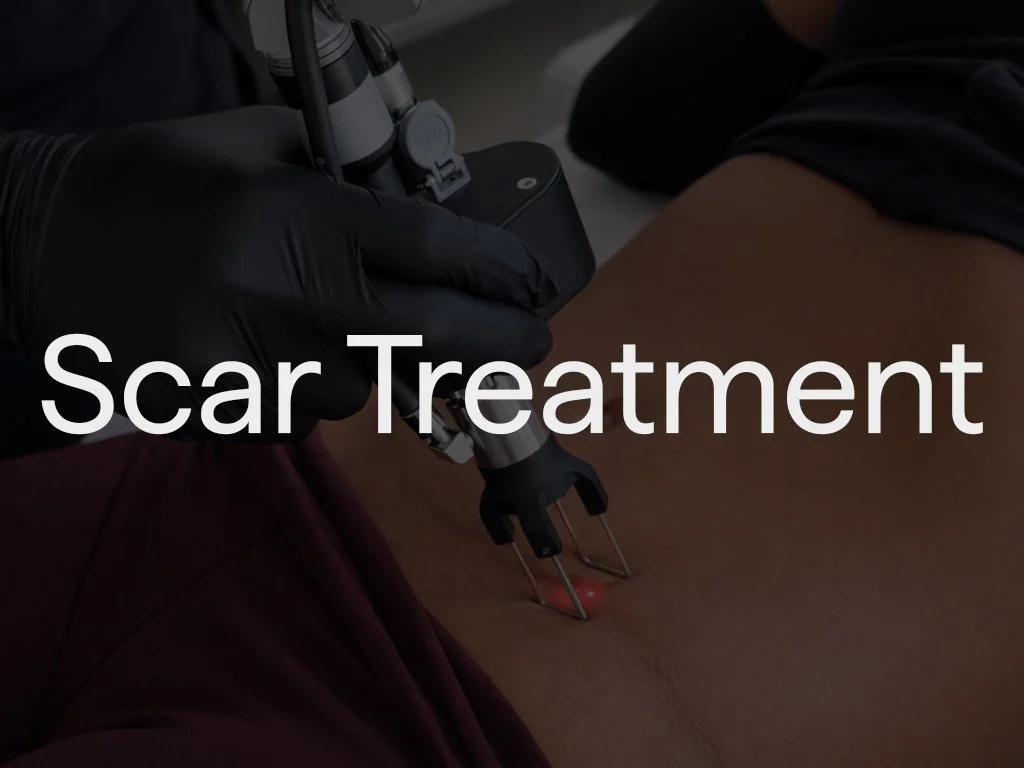 Scar revision treatment improves the appearance of unwanted scars, including those following procedures such as a tummy tuck. Depending on the scar type, treatment may involve laser therapy, targeted injections, or minor surgical refinement to smooth