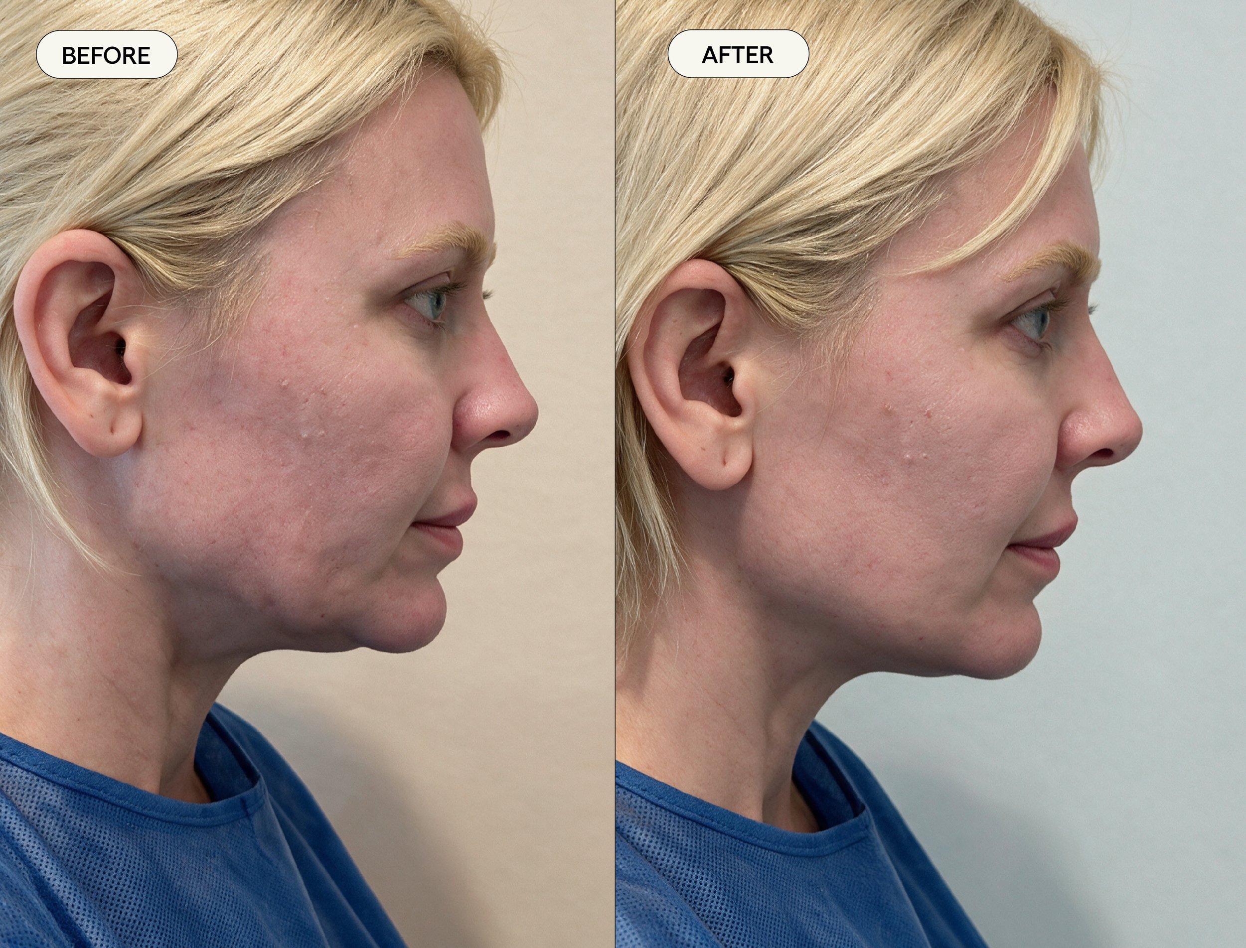Side-by-side comparison of a woman's neck and jawline before and after a cosmetic procedure jawtite shows a smoother, more defined profile in the after image.