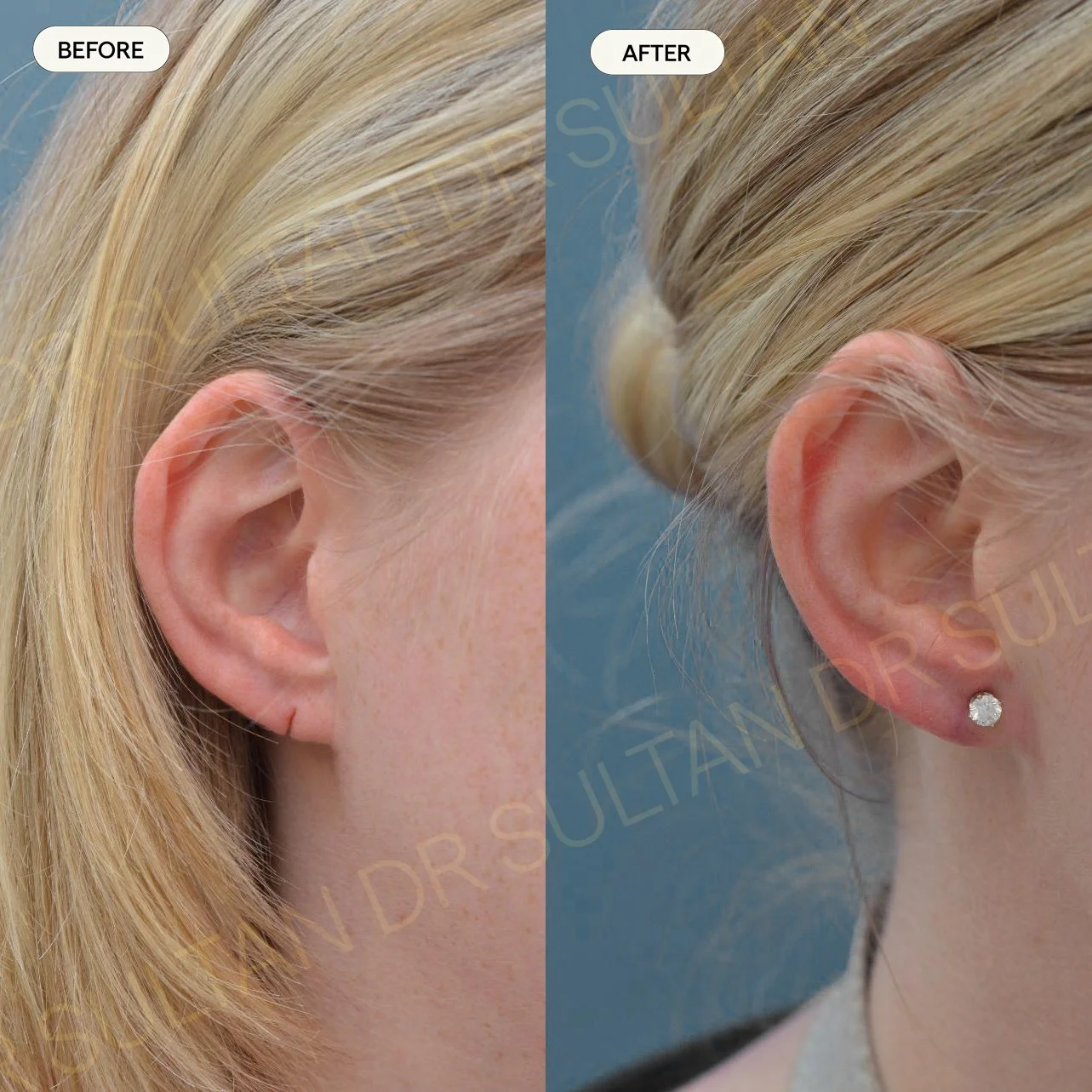Ear lobe repair from ear piercing