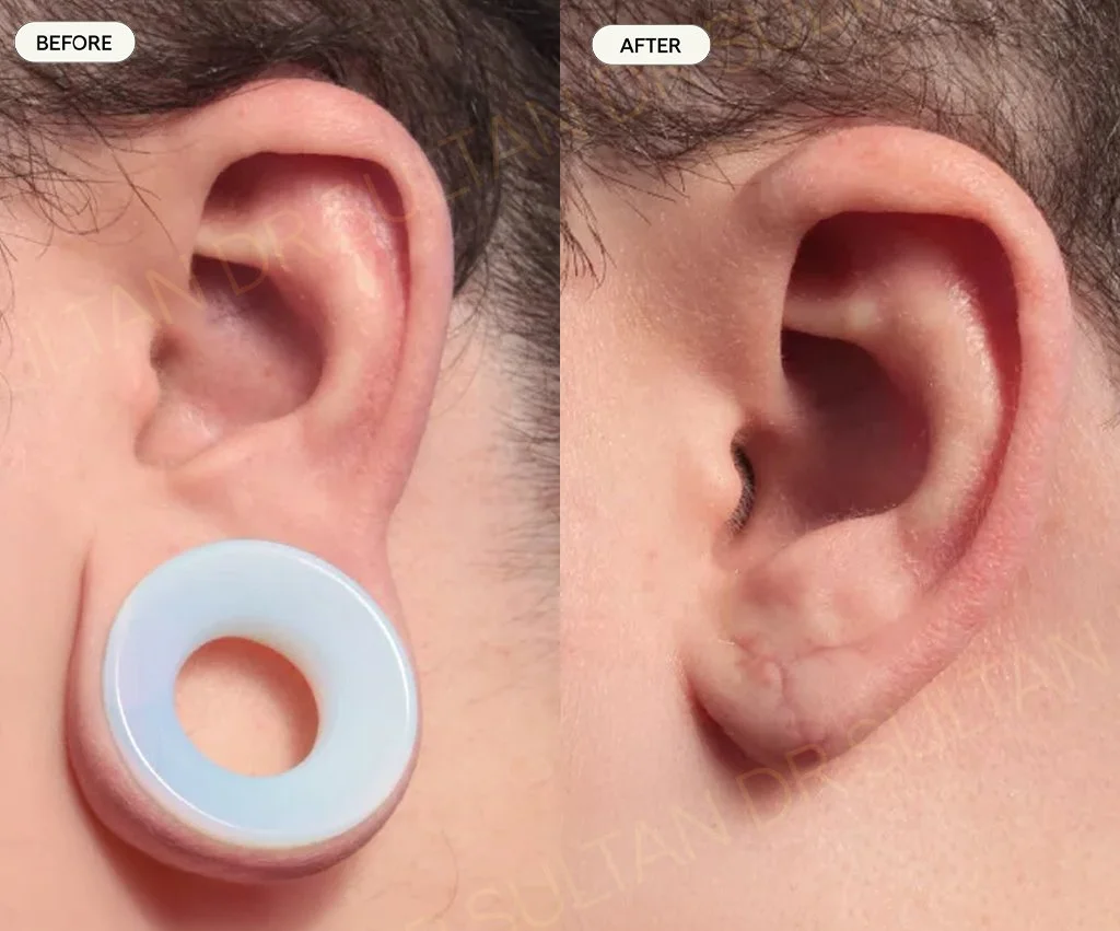 Gauged ear piercing repair 