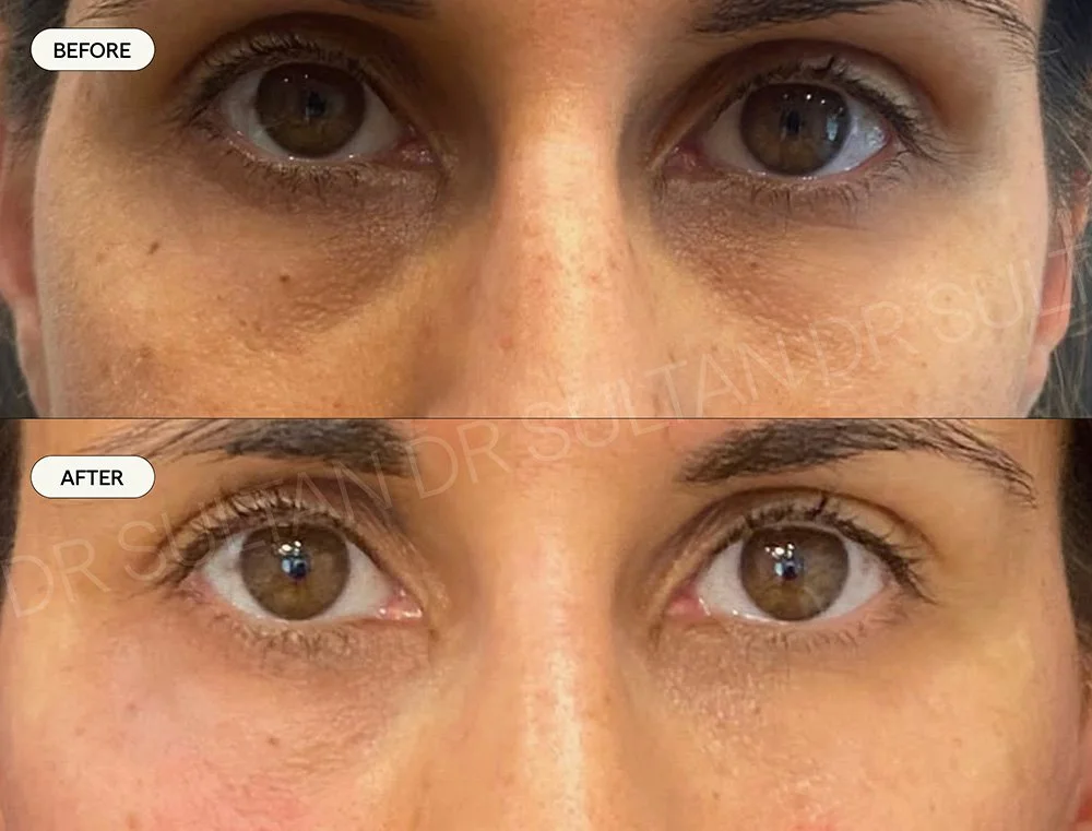 Tear trough rejuvenation with mid face and under eye filler 