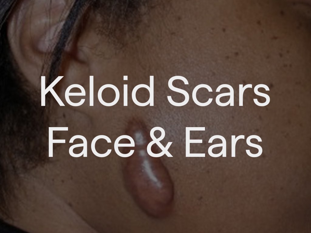Keloid scars on the face and ears can be treated with targeted steroid injections or minor surgical removal. Treatment aims to flatten the scar, reduce symptoms such as itching or discomfort, and improve overall appearance while minimising recurrence
