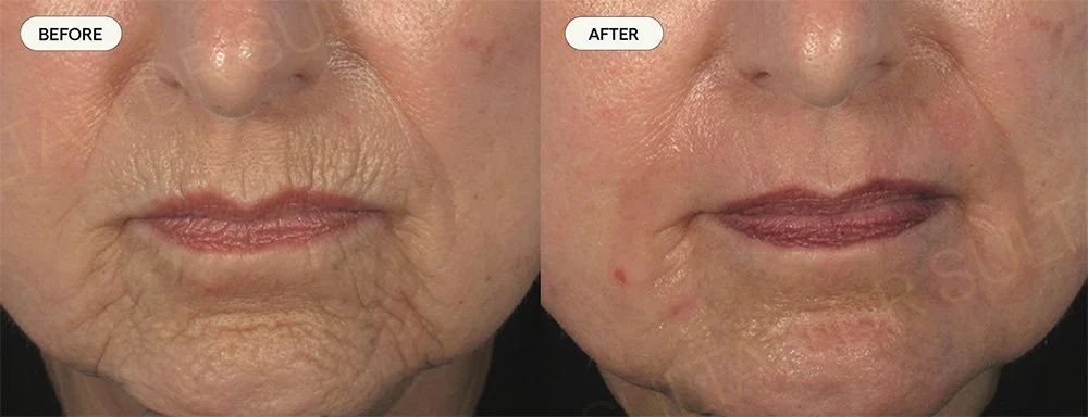 Before and 6 months after one treatment for peri-oral wrinkles