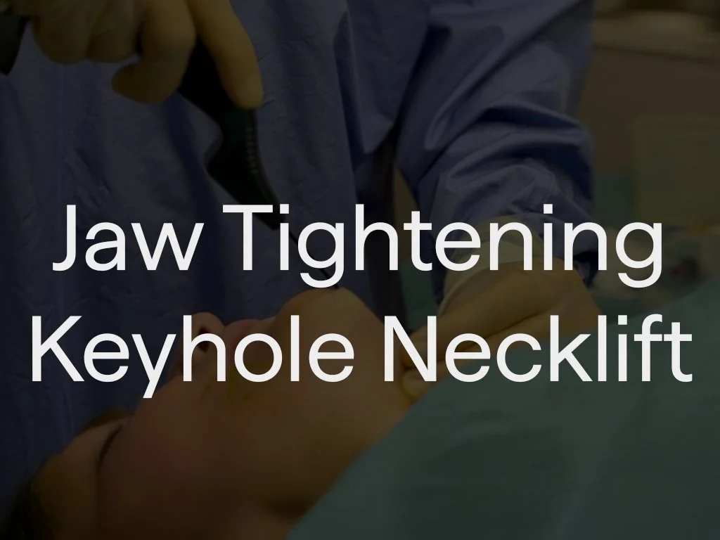 This delivers significant tightening and contouring of the lower face and jawline, offering results comparable to a lower facelift without the need for traditional surgery. Using advanced RF technology, it melts excess fat and contracts the skin to c