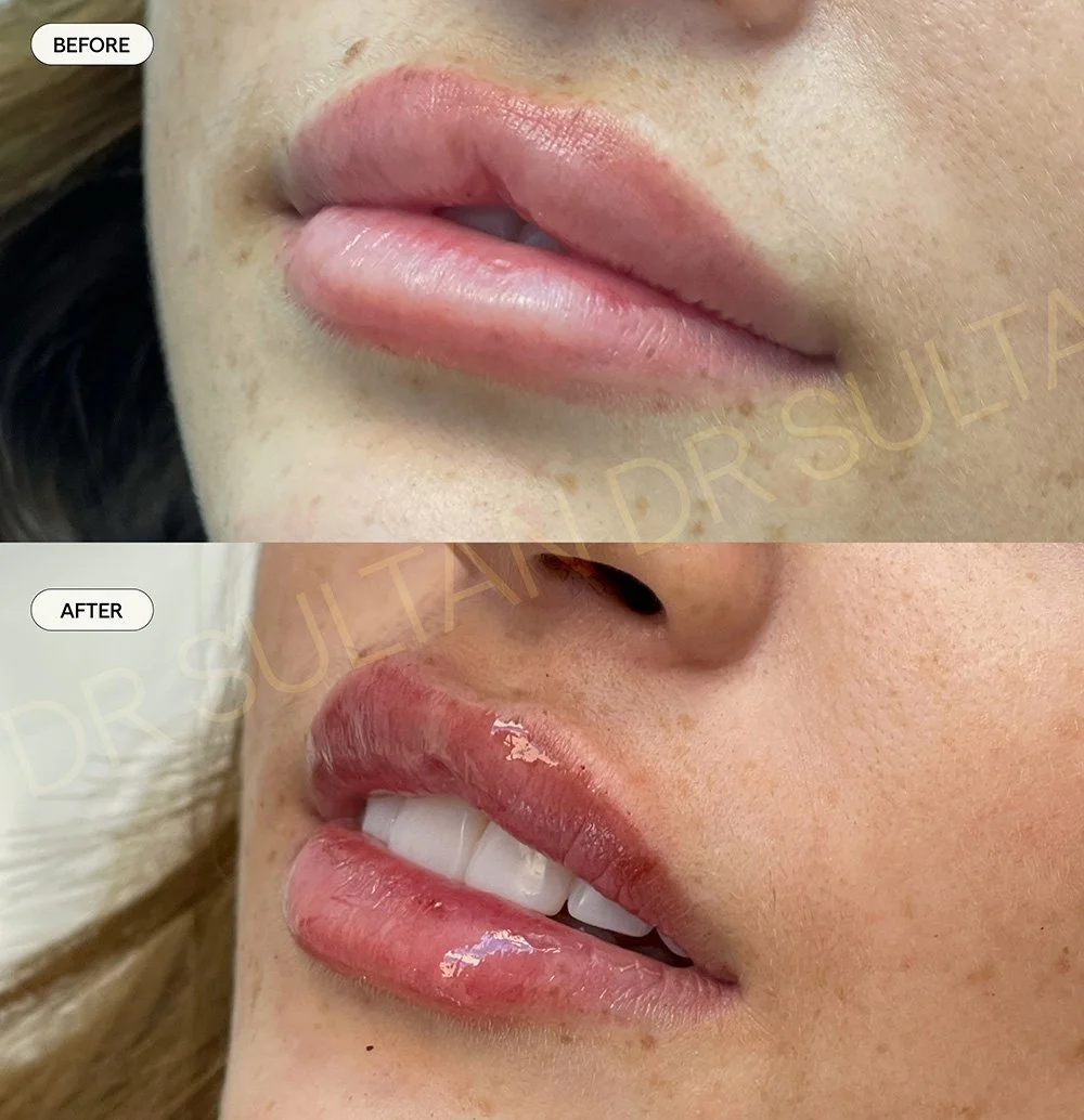 Correction of previous lip filler with scarring in the top lip 