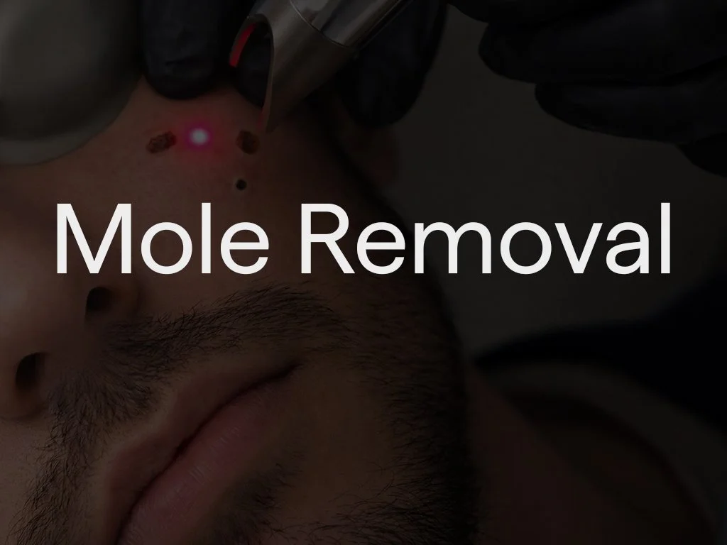 Moles and other skin lumps and bumps can be safely removed using CO₂ laser, minor surgical excision, or cryotherapy (freezing), depending on the type and location. The most appropriate method is selected following assessment to ensure effective remov