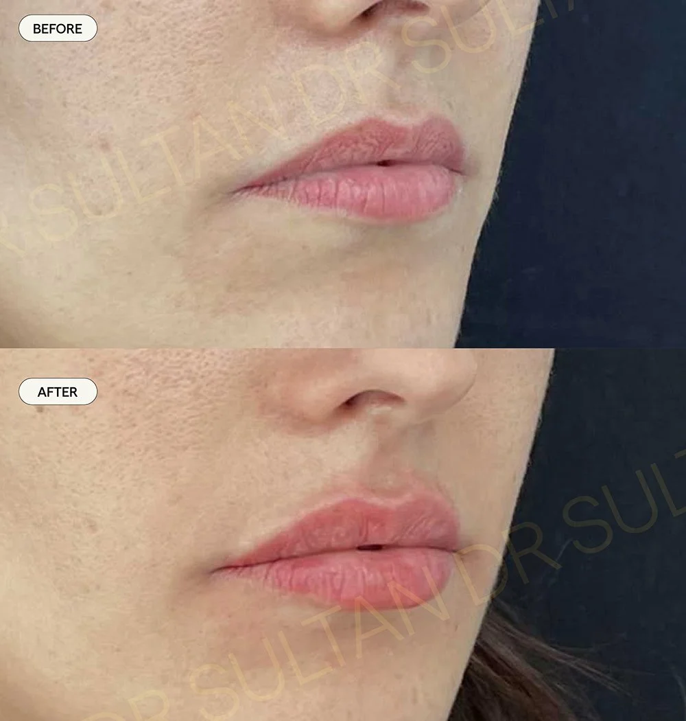 Lip filler cannula technique for a natural look