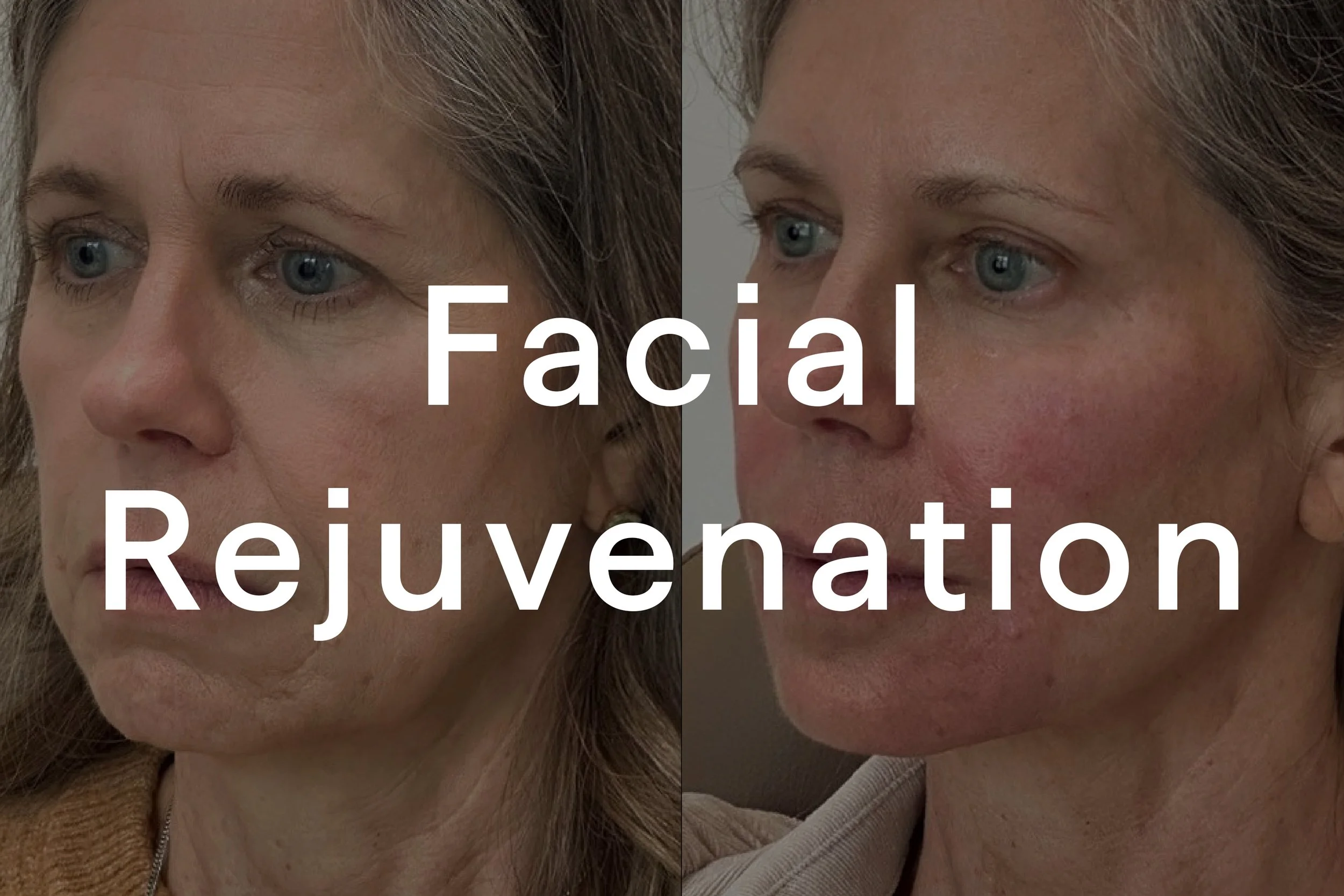 Face_Rejuvenate.jpg