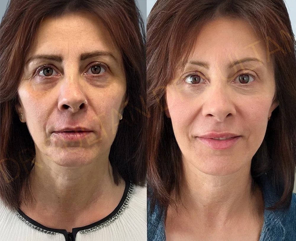 Full face rejuvenation using dermal fillers and botox. 