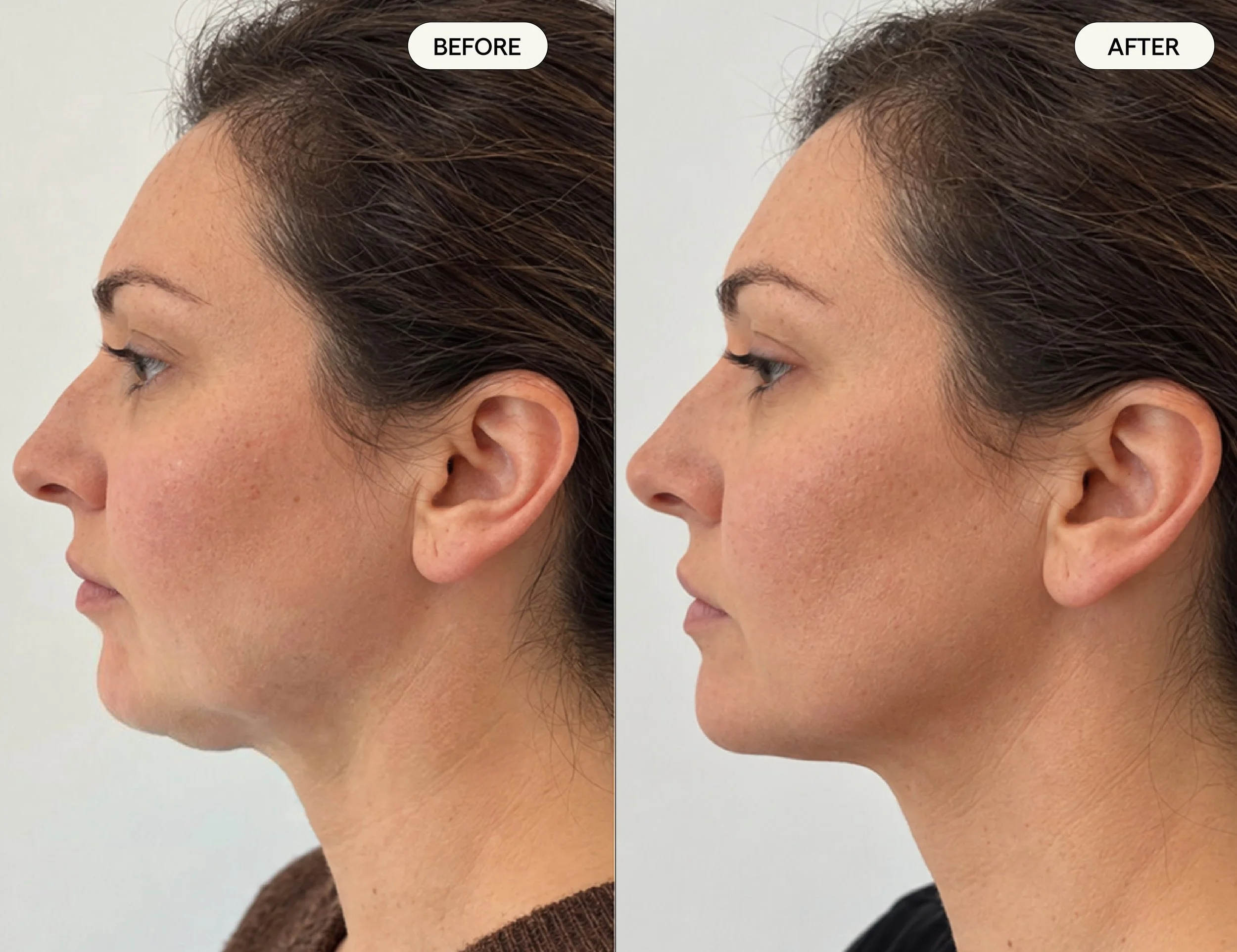 Side-by-side comparison of a woman's neck and jawline before and after a cosmetic procedure facetite showing a smoother, more defined profile in the after image.