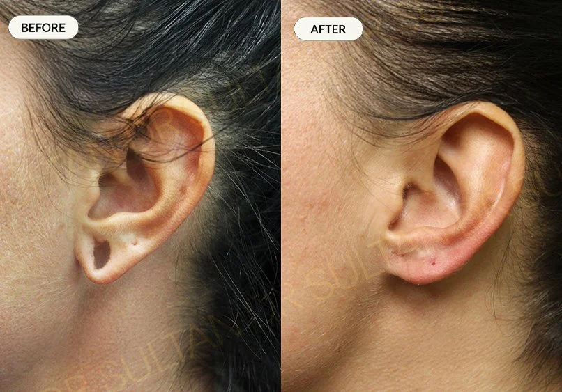 Stretch ear piercing. Repaired with less than 1 week healing