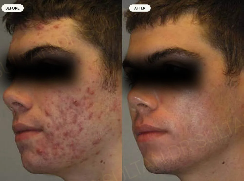 Acne scarring treated with two sessions of CO2 laser