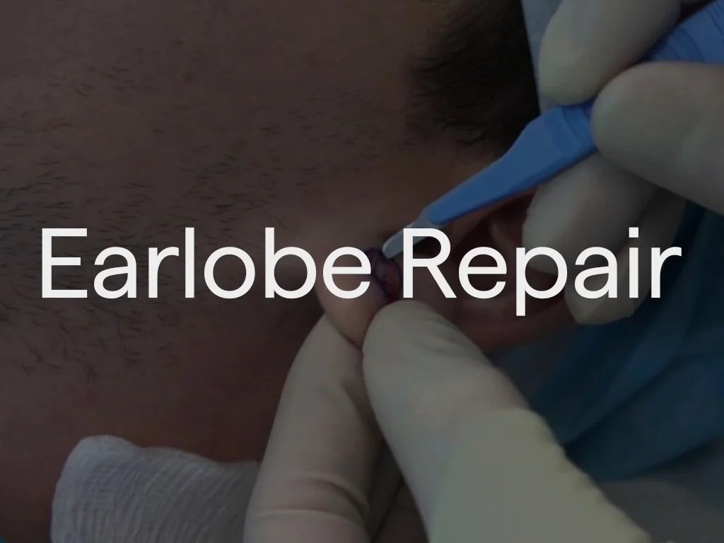 Dr Sultan’s earlobe repair restores stretched, torn, or ageing earlobes using a tailored approach. Treatment may include precise minor surgery, dermal filler to restore lost volume, or laser to refine skin quality, creating a natural and balanced res