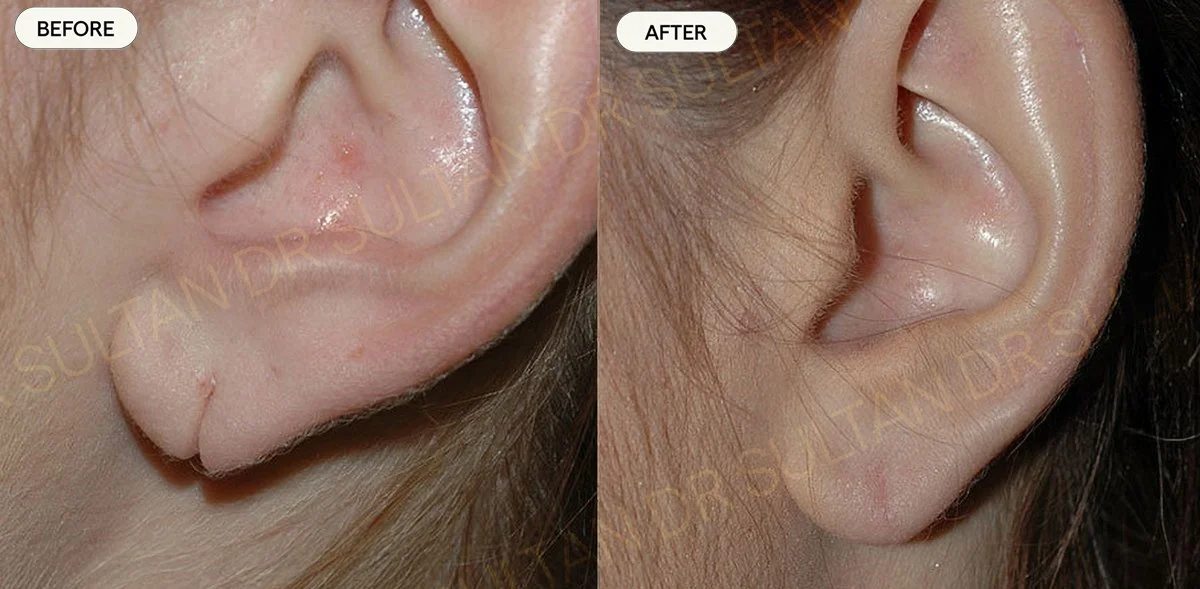 Ear lobe repair 