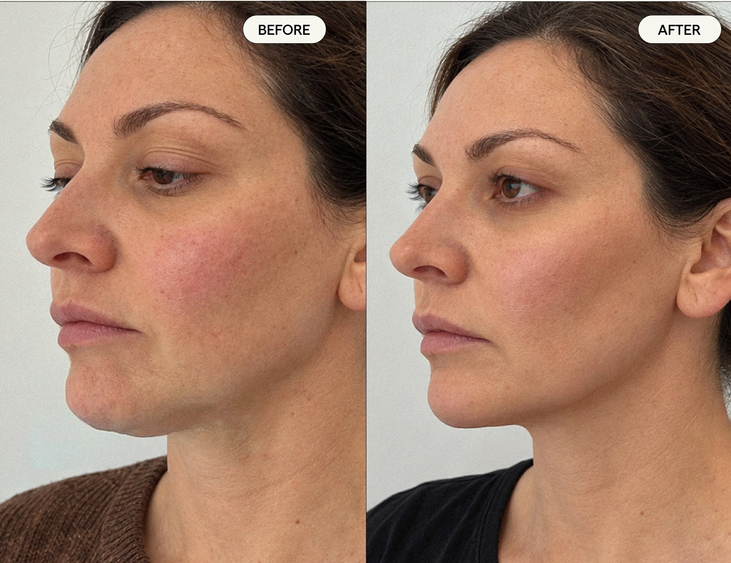 Side-by-side comparison of a woman's neck and jawline before and after a cosmetic procedure quantum shows a smoother, more defined profile in the after image.