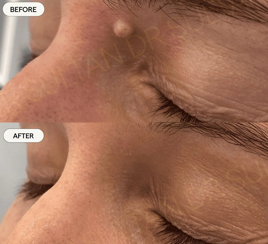 Mole removal with CO2. Before and after one treatment. 