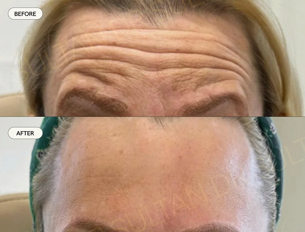 Botox, anti wrinkle, dr sultan