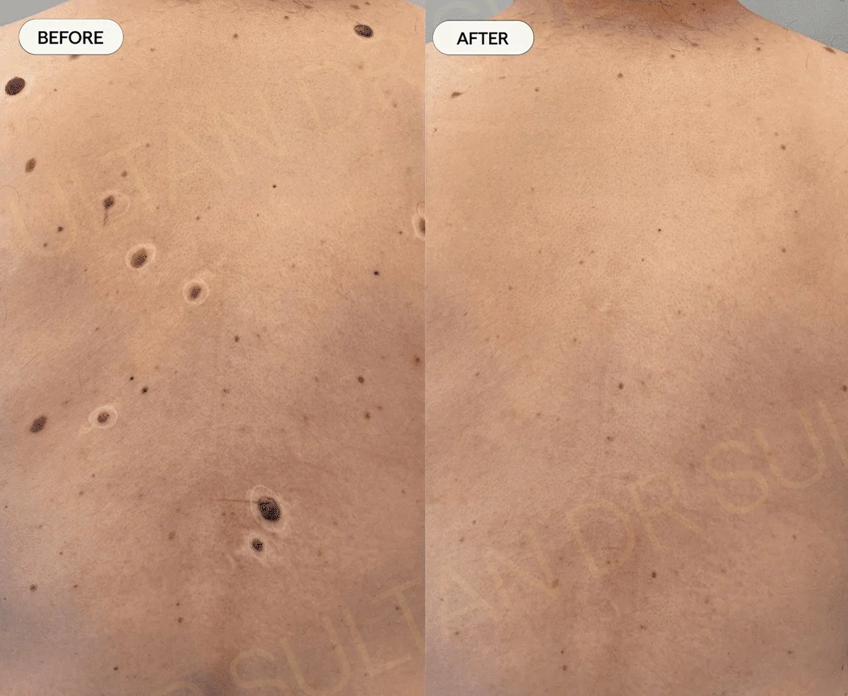 Back moles removal with CO2. Before and after one treatment. 