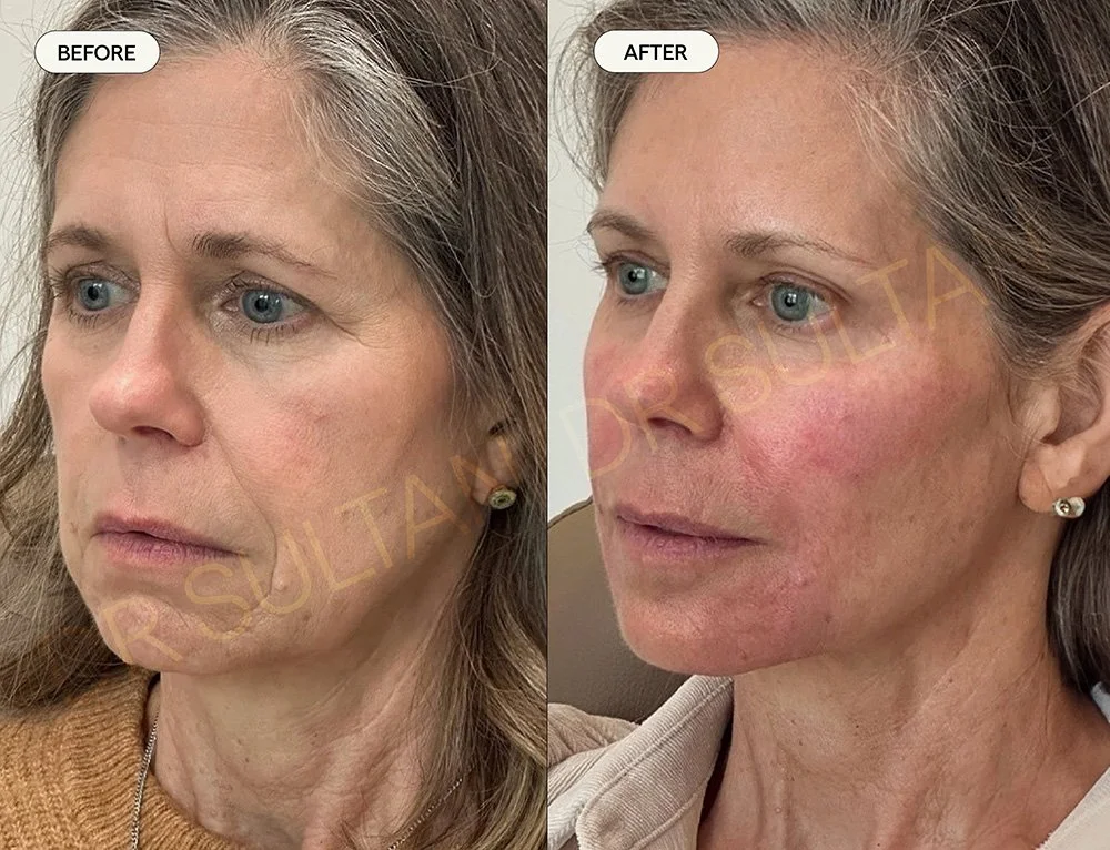 Full Face Rejuvenation using dermal fillers 