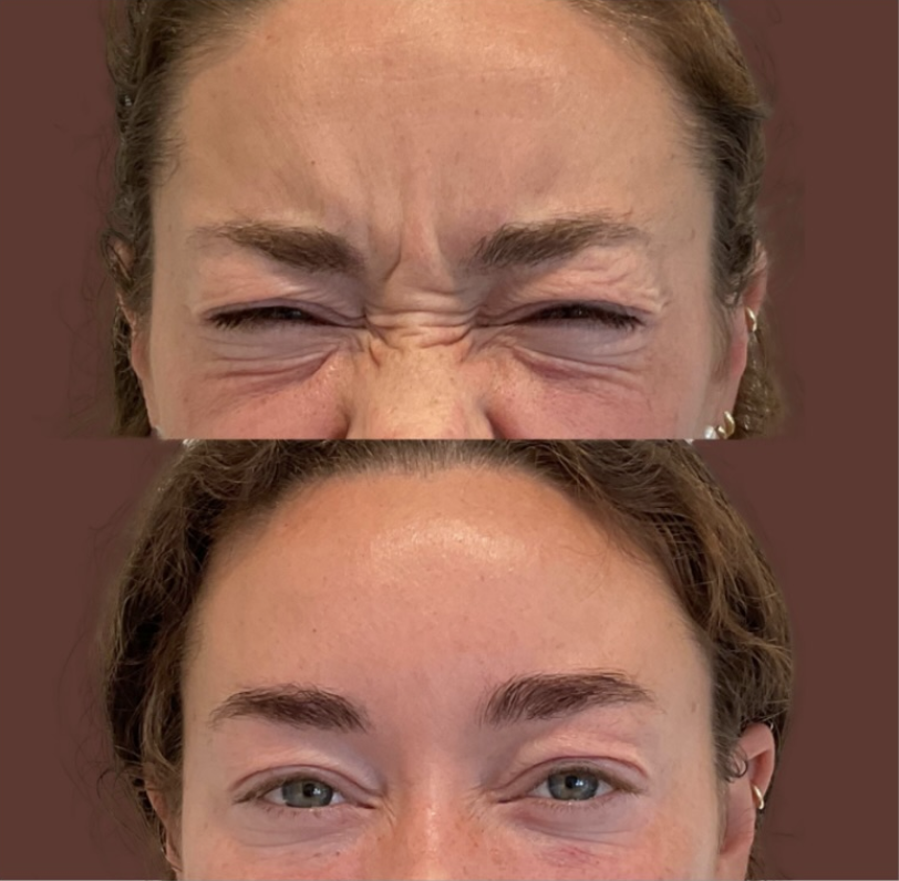 Botox before and after