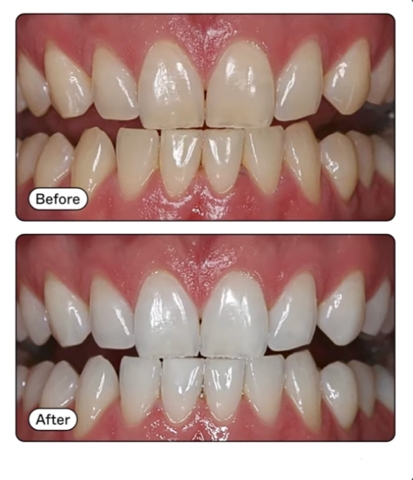 Professional teeth whitening treatment at Muse Aesthetics and Dentistry in Del Mar