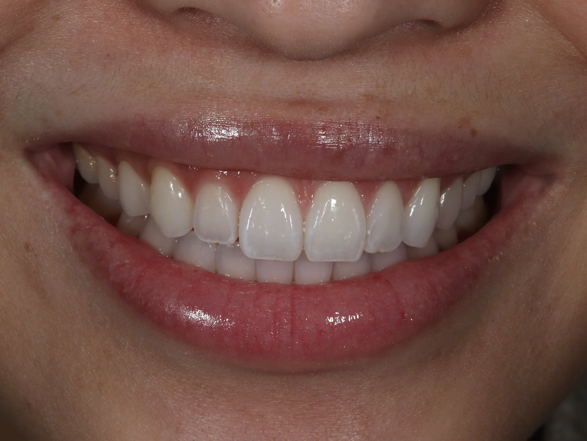 Will My Veneers Look Fake? An Honest Answer from a Cosmetic Dentist