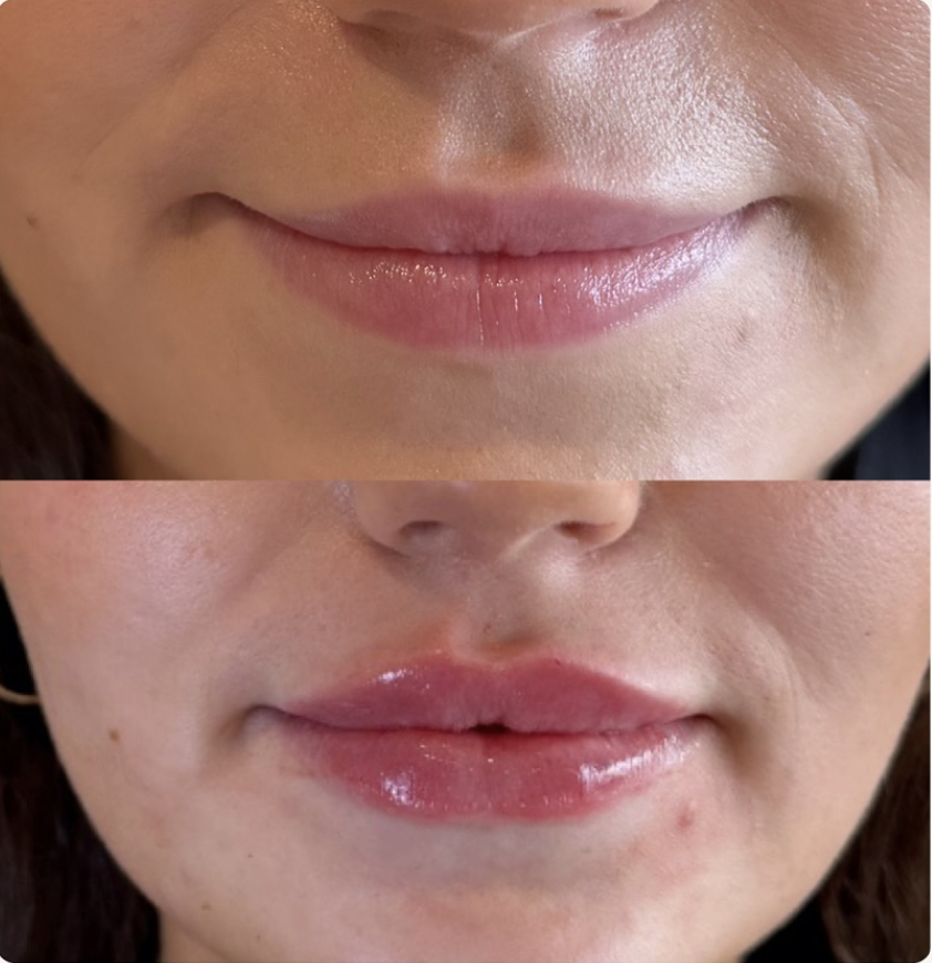 Lip filler before and after