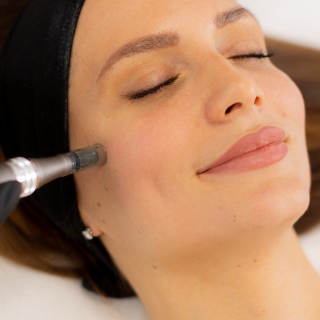 Microneedling skin rejuvenation treatment at Muse Aesthetics in Del Mar