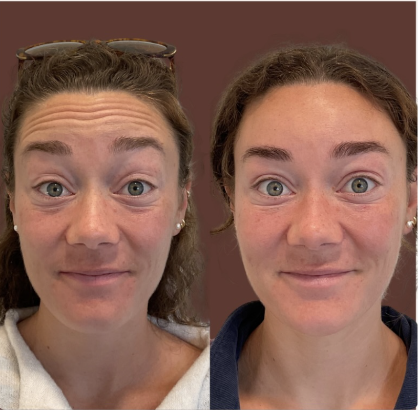 Botox before and after