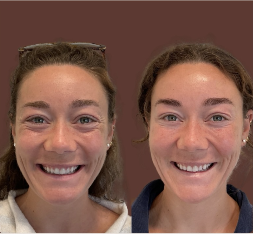 Botox before and after