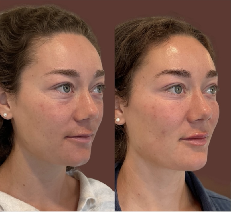 Botox before and after
