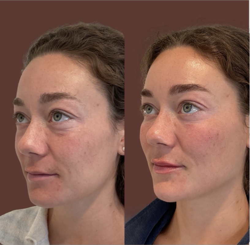 Botox before and after