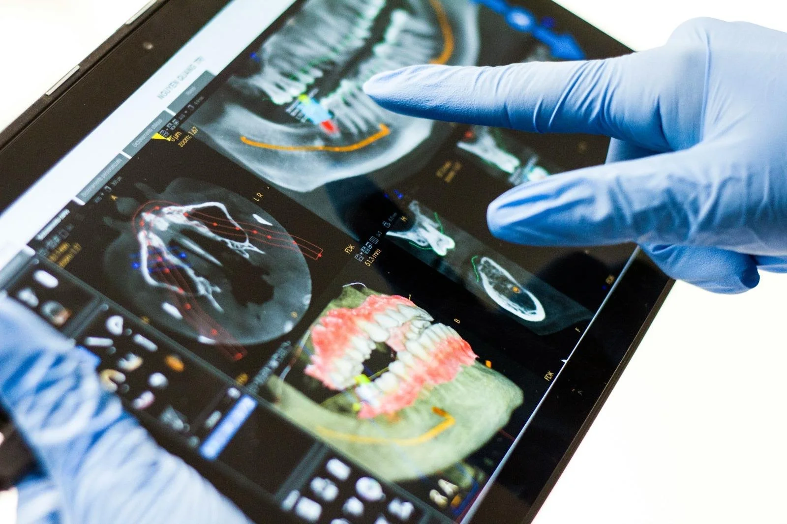 A person wearing blue latex gloves examining a digital display of dental X-ray images and 3D mouth scans on a tablet.