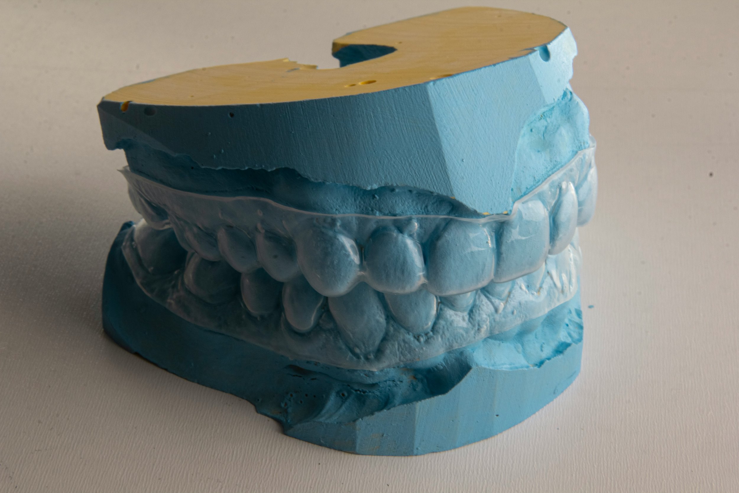 A blue plaster dental mold of a human jaw with teeth, showcasing upper and lower dental arches on a white surface.