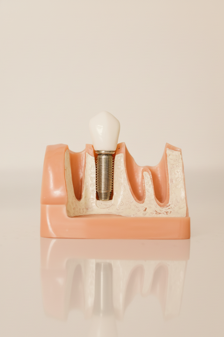 A dental model showing a dental implant with a prosthetic tooth on top of the gum and bone tissue.