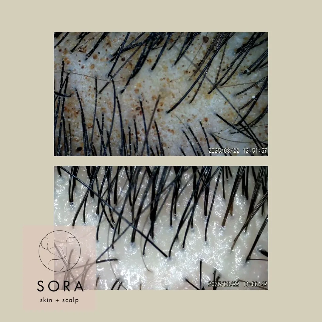 Over time, styling products, oils, dry shampoo can accumulate on the scalp, creating a barrier that clogs follicles and traps excess sebum. Research shows that this buildup can contribute to scalp inflammation, disrupt the hair growth cycle, and, in 
