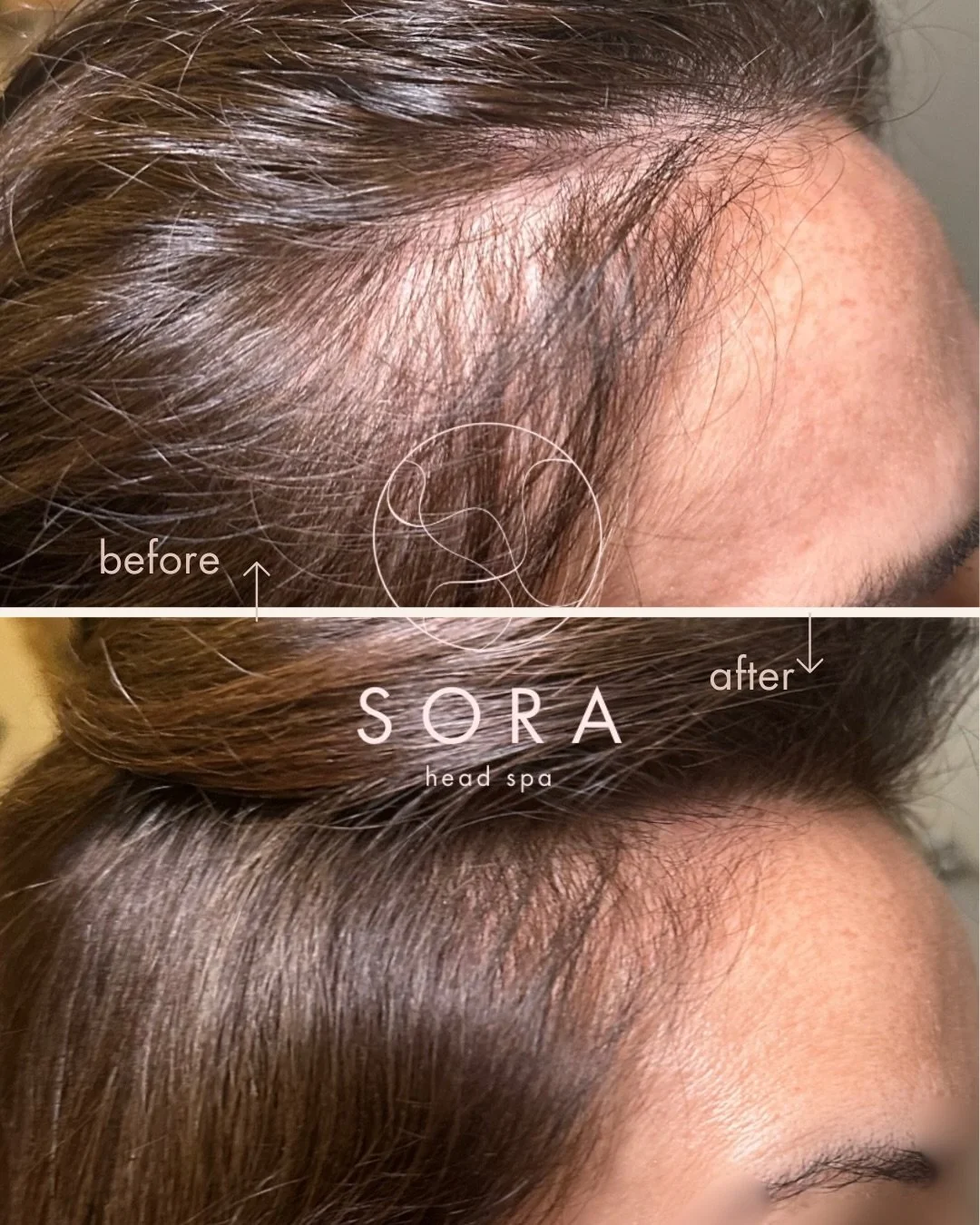 Procell Microchanneling for Hair Regrowth Results ✨

This lovely client was experiencing hair thinning around her hair line and came in for her first microchanneling treatment for hair regrowth in November. These results are after 5 microchanneling t