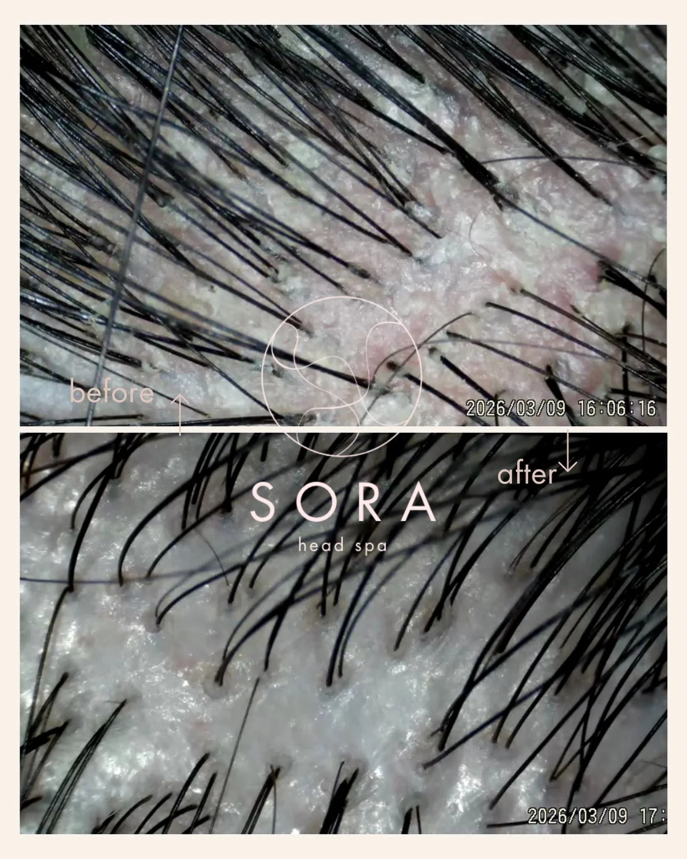 If your scalp is itchy and flaky, let us help you discover why. Sometimes we might confuse it as dryness when in reality it&rsquo;s caused by oiliness or vise versa. Not using the right products for your scalp can exasperate the issue. For this parti