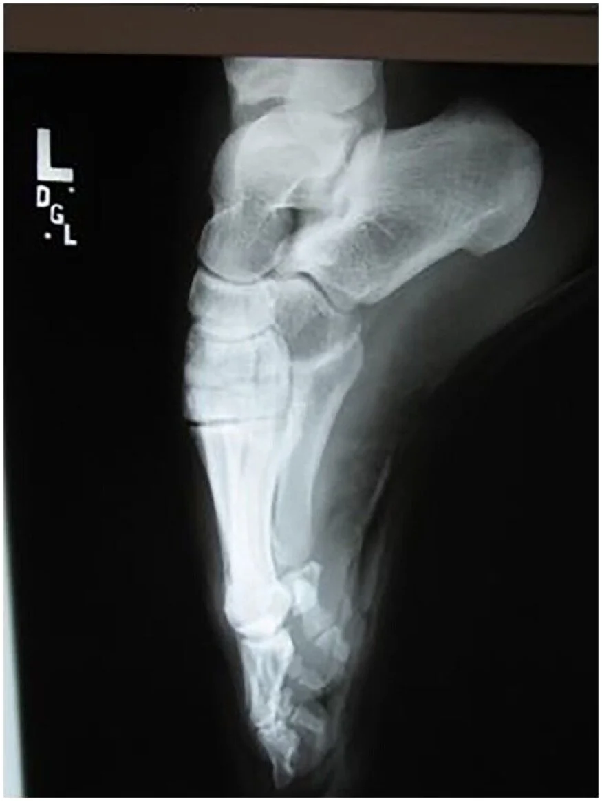 The Pointe Problem: Our Best Determinants for Success in Pre-Pointe Dancers