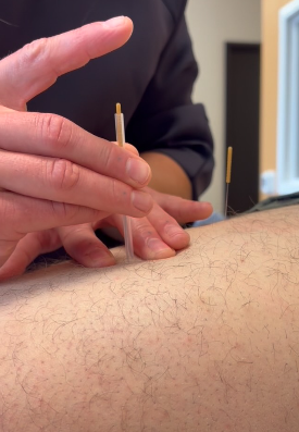 dry needling DN