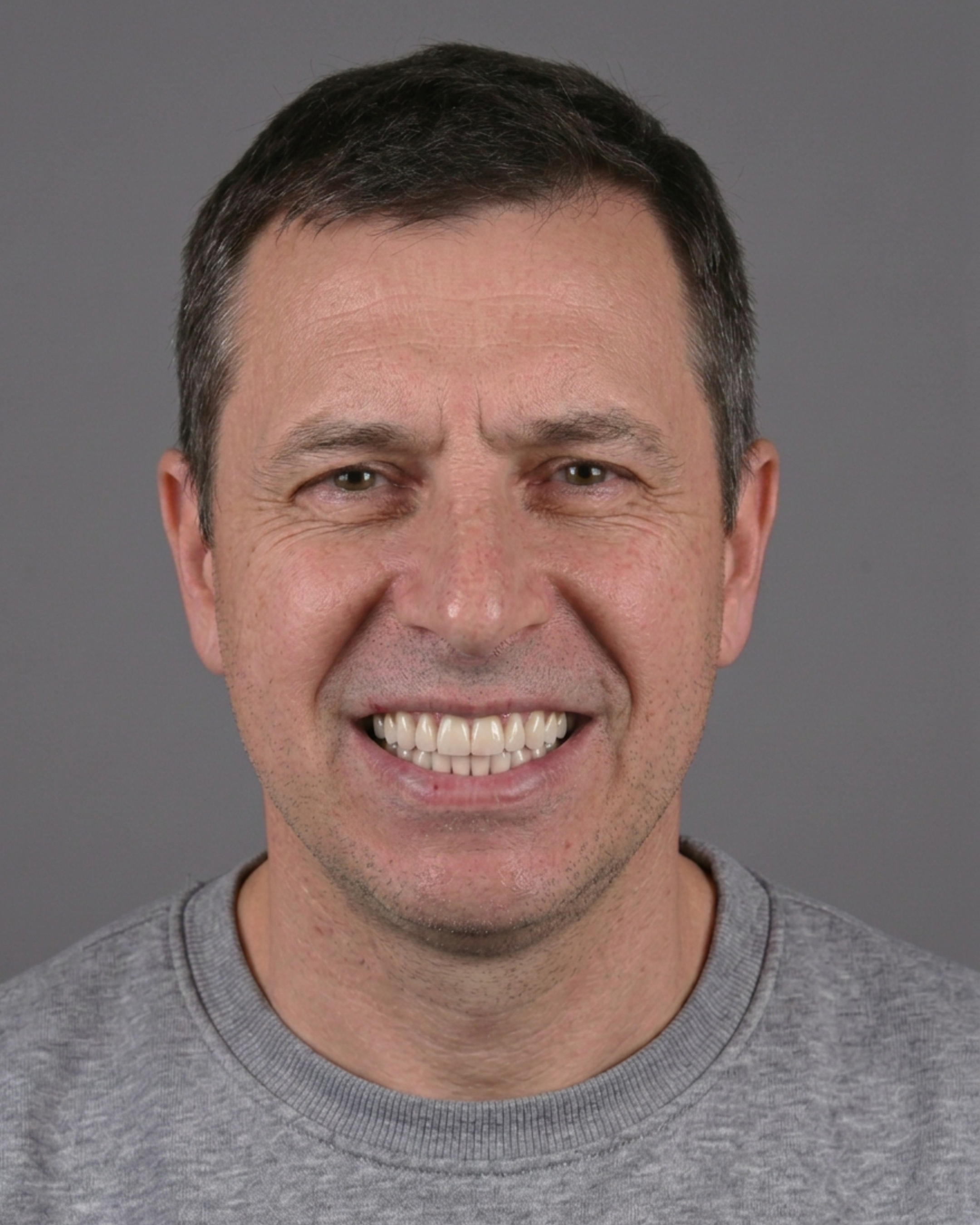 Implant Restoration (3).png